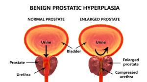 Prostate problems can impact urination and sexual function